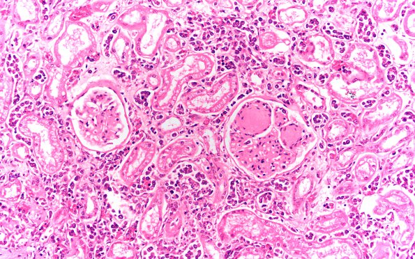 12E Lymphoma, intravascular (Case 12) L1 20X 2