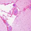 14A1 Lymphoma, IV (Case 14) H&E 11