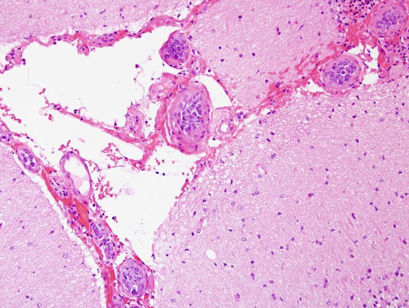 14A1 Lymphoma, IV (Case 14) H&E 11