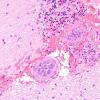 14A2 Lymphoma, IV (Case 14) H&E 13