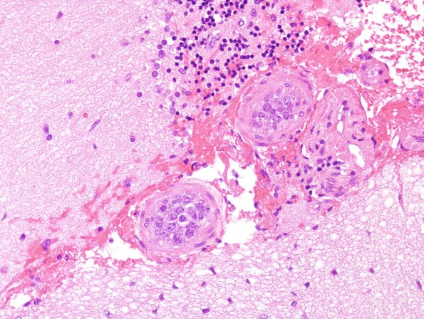 14A2 Lymphoma, IV (Case 14) H&E 13