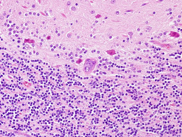 14A3 Lymphoma, IV (Case 14) H&E 1