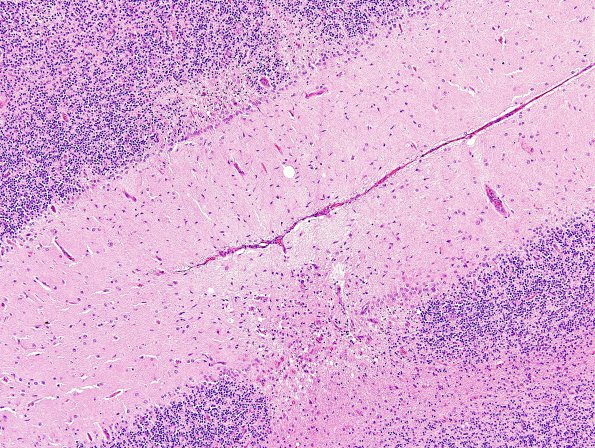 14A4 Lymphoma, IV (Case 14) H&E 7