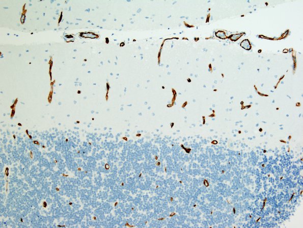 14B1 Lymphoma, IV (Case 14) CD34 3