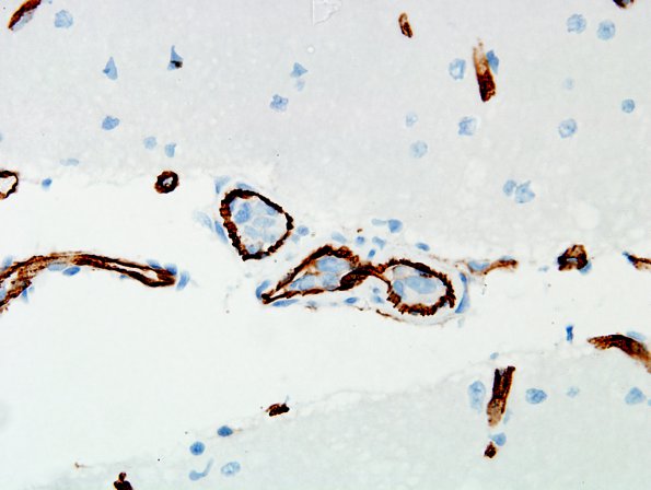 14B2 Lymphoma, IV (Case 14) CD34 5