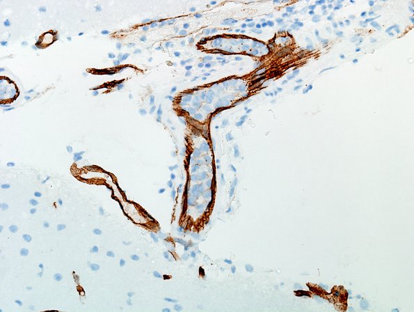 14B3 Lymphoma, IV (Case 14) CD34 6