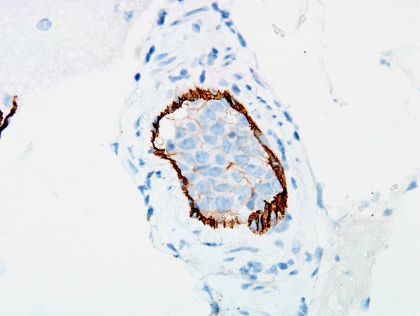 14B4 Lymphoma, IV (Case 14) CD34 7