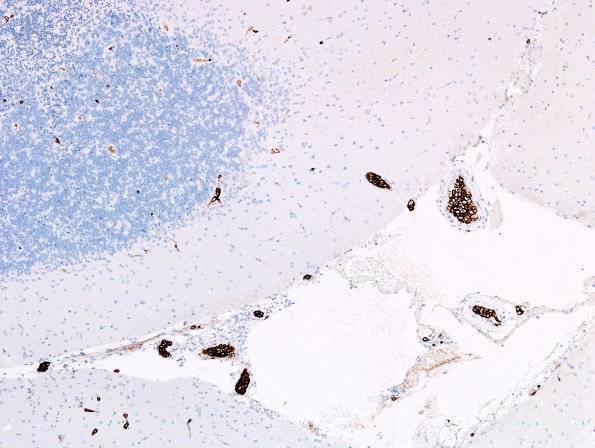 14C1 Lymphoma, IV (Case 14) CD20 8