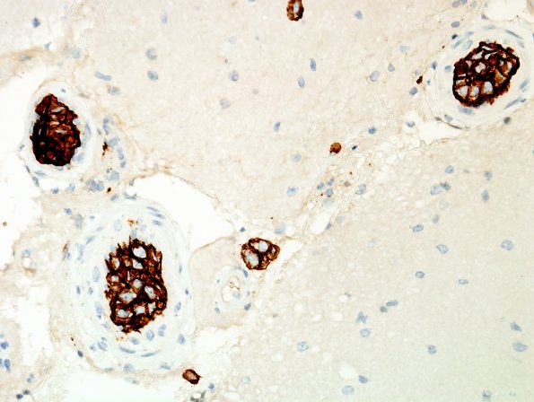 14C2 Lymphoma, IV (Case 14) CD20 2