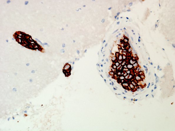 14C3 Lymphoma, IV (Case 14) CD20 10.