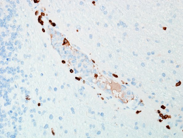 14D Lymphoma, IV (Case 14) CD3 2.