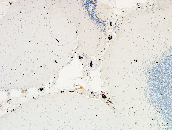 14E1 Lymphoma, IV (Case 14) Ki67 4.j