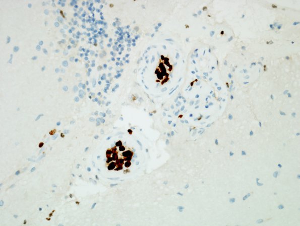 14E2 Lymphoma, IV (Case 14) Ki67 6