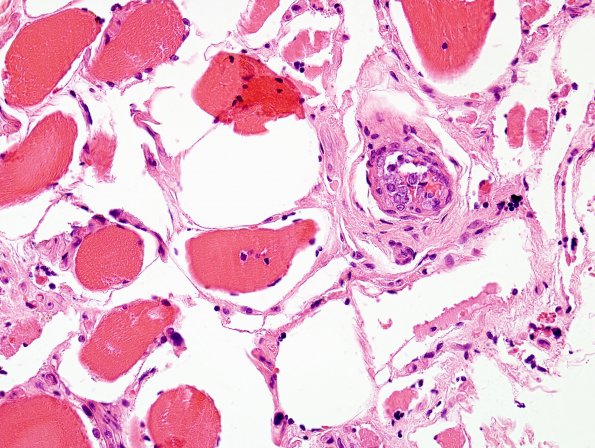 15A1 Lymphoma, IV Muscle (Case 15) H&E 10