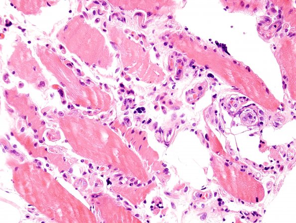 15A2 Lymphoma, IV Muscle (Case 15) H&E 14