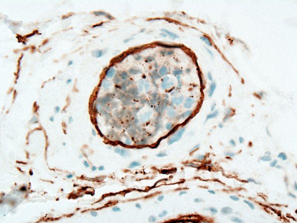 15B1 Lymphoma, IV Muscle (Case 15) CD34 1 (2)