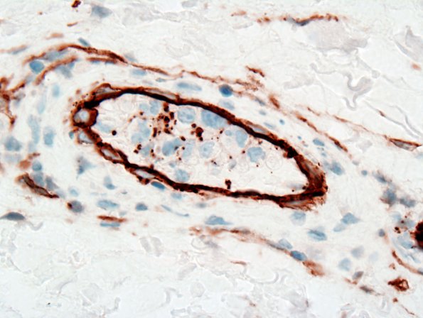 15B2 Lymphoma, IV Muscle (Case 15) CD34 2 (2).