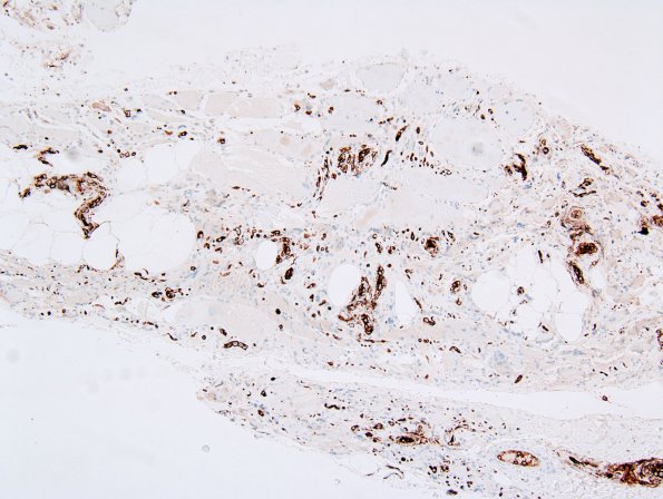 15C1 Lymphoma, IV Muscle (Case 15) CD20 1 (2)