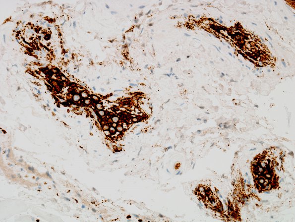 15C2 Lymphoma, IV Muscle (Case 15) CD20 3