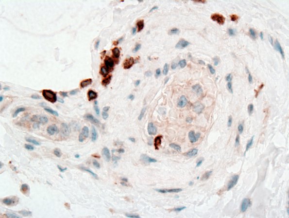 15D Lymphoma, IV Muscle (Case 15) CD3 2
