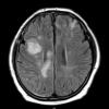 16A1 Lymphoma, intravascular (Case 16) FLAIR - Copy