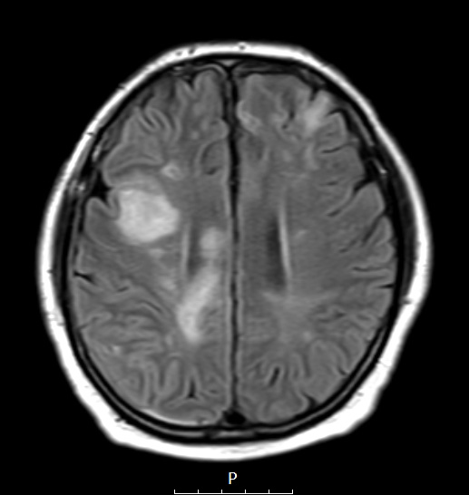 16A1 Lymphoma, intravascular (Case 16) FLAIR - Copy