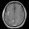 16A2 Lymphoma, intravascular (Case 16) 1 post contrast - Copy