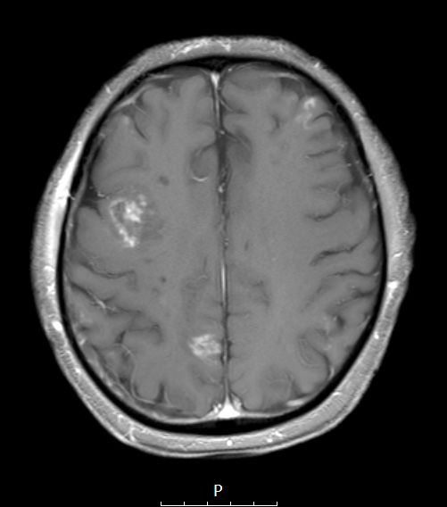 16A2 Lymphoma, intravascular (Case 16) 1 post contrast - Copy