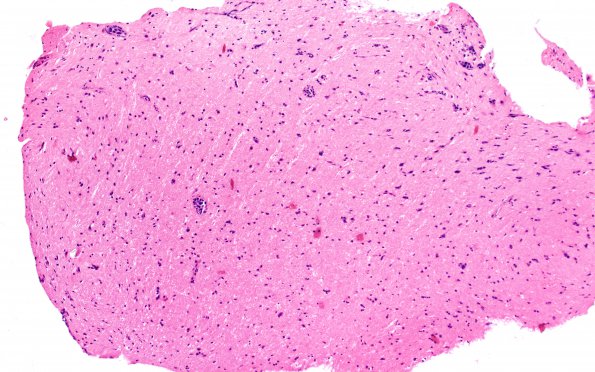 16B1 Lymphoma, intravascular (Case 16) H&E 10X