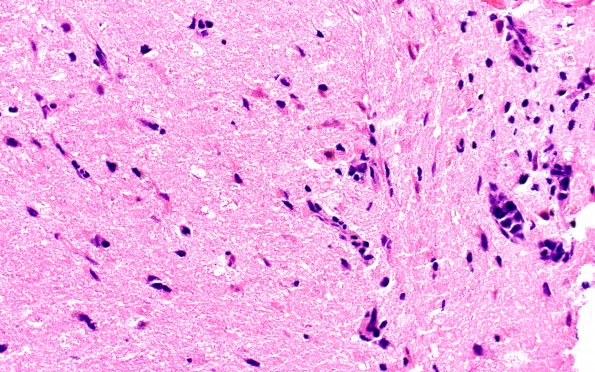 16B2 Lymphoma, intravascular (Case 16) H&E 40X 1