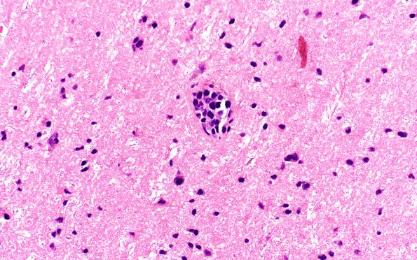 16B3 Lymphoma, intravascular (Case 16) H&E 40X 2