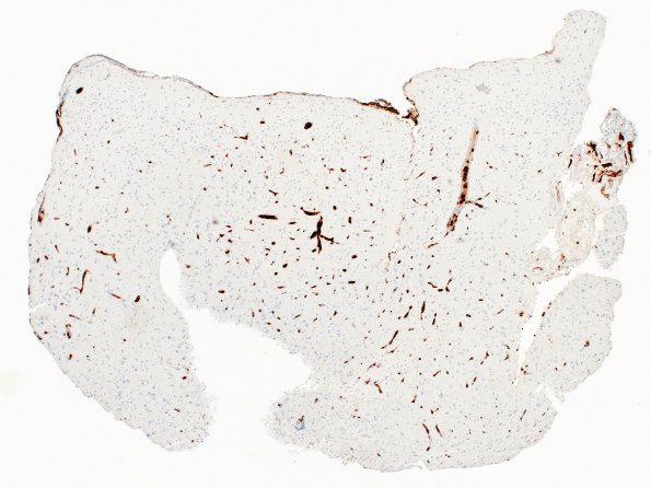 16C1 Lymphoma, intravascular (Case 16) CD20 4X 1