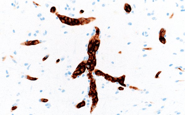 16C3 Lymphoma, intravascular (Case 16) CD20 40X 1