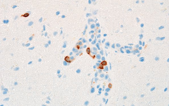 16D3 Lymphoma, intravascular (Case 16) CD3 60X 1