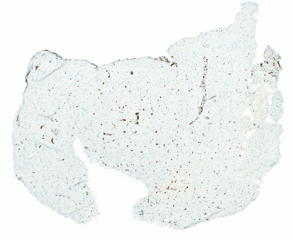 16E1 Lymphoma, intravascular (Case 16) Ki67 4X 1