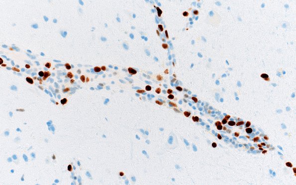 16E2 Lymphoma, intravascular (Case 16) Ki67 40X 1