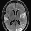 17A1 Lymphoma, intravascular (Case 17) T2 - Copy