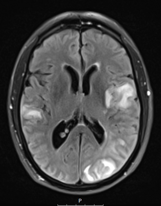 17A1 Lymphoma, intravascular (Case 17) T2 - Copy