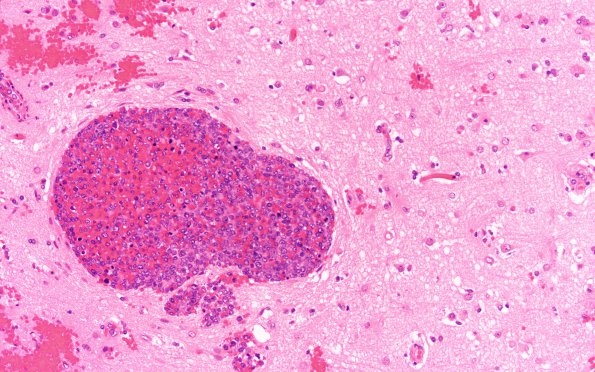 17B1 Lymphoma, intravascular (Case 17) B1 H&E 20X