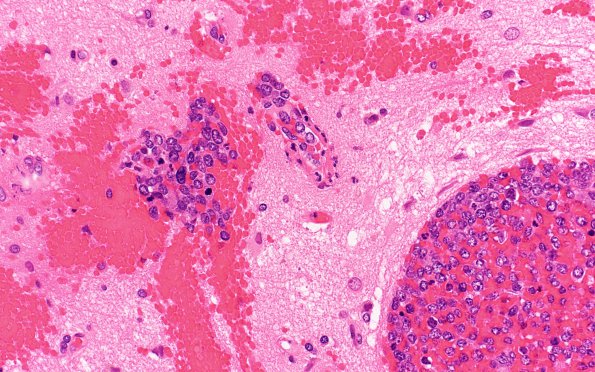 17B2 Lymphoma, intravascular (Case 17) B1 H&E 40X 2