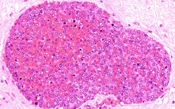 17B3 Lymphoma, intravascular (Case 17) B1 H&E 40X