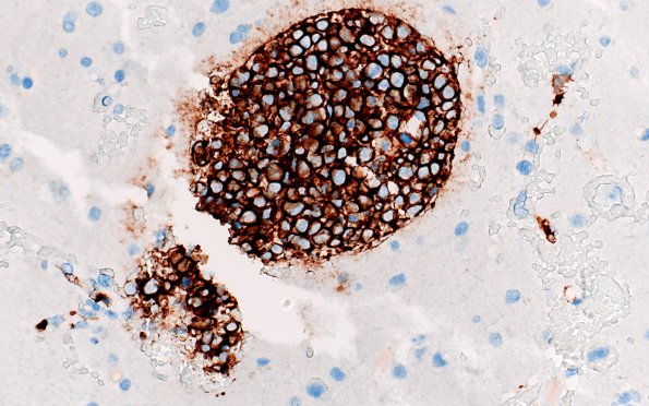 17B4 Lymphoma, intravascular (Case 17) B1 CD20 40X