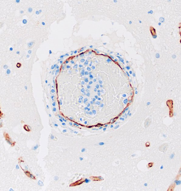 17B6 Lymphoma, intravascular (Case 17) CD34 20X match A