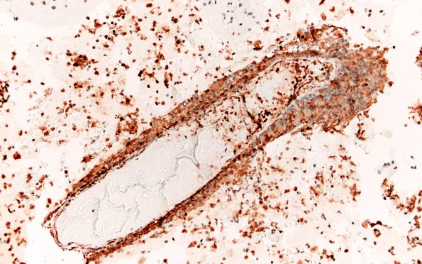 17B8 Lymphoma, intravascular (Case 17) B1 SMA 20X 2