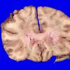 17C1 Lymphoma, intravascular (Case 17) _10A