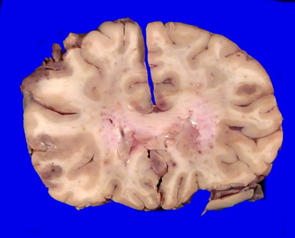 17C1 Lymphoma, intravascular (Case 17) _10A