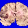 17C2 Lymphoma, intravascular (Case 17) _13