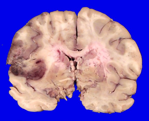 17C2 Lymphoma, intravascular (Case 17) _13