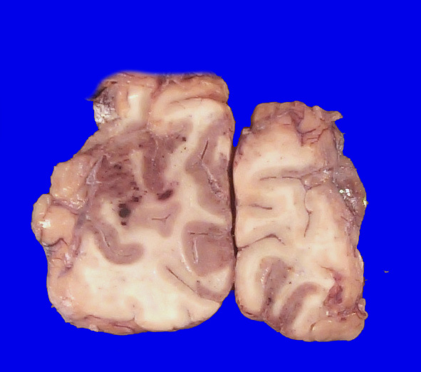 17C3 Lymphoma, intravascular (Case 17) _25