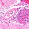 17D4 Lymphoma, intravascular (Case 17) N1 H&E 20X